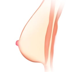 Solid Breast